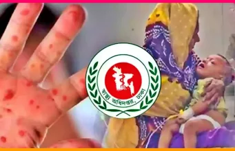 হামে মৃত্যুমিছিল: ২৪ ঘণ্টায় আরও ১২ শিশুর প্রাণহানি, মোট মৃত্যু ৪৫১ হামে শিশুর মৃত্যু
