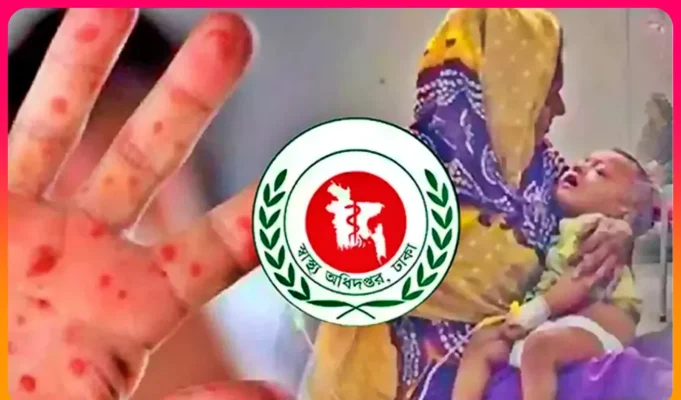 হামে মৃত্যুমিছিল: ২৪ ঘণ্টায় আরও ১২ শিশুর প্রাণহানি, মোট মৃত্যু ৪৫১ হামে শিশুর মৃত্যু