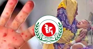 হাম ও উপসর্গে একদিনে রেকর্ড ১৭ জনের মৃত্যু: এক বছরের সর্বোচ্চ হাম আক্রান্ত রোগী ও স্বাস্থ্য সচেতনতা