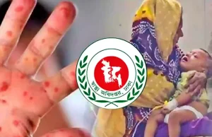 হাম ও উপসর্গে একদিনে রেকর্ড ১৭ জনের মৃত্যু: এক বছরের সর্বোচ্চ হাম আক্রান্ত রোগী ও স্বাস্থ্য সচেতনতা