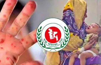 হাম ও উপসর্গে একদিনে রেকর্ড ১৭ জনের মৃত্যু: এক বছরের সর্বোচ্চ হাম আক্রান্ত রোগী ও স্বাস্থ্য সচেতনতা
